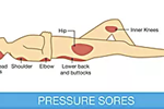 The pressure ulcer problem