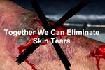 Skin tears can have serious consequences for patients with frail skin
